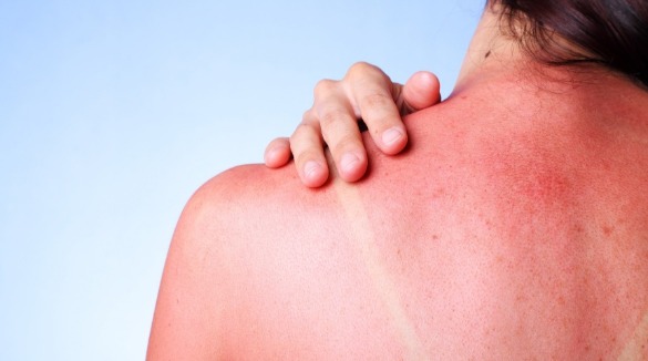sunburned skin | Sunset Vacations